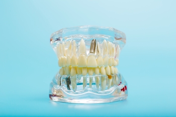 reasonable price dental implants perth