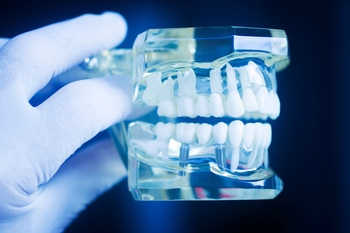 implant dentist abroad perth